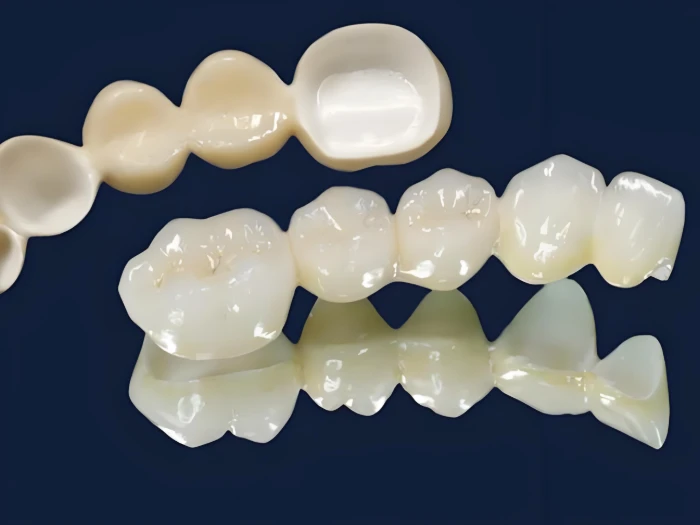 Preu i característiques de les corones de zirconia